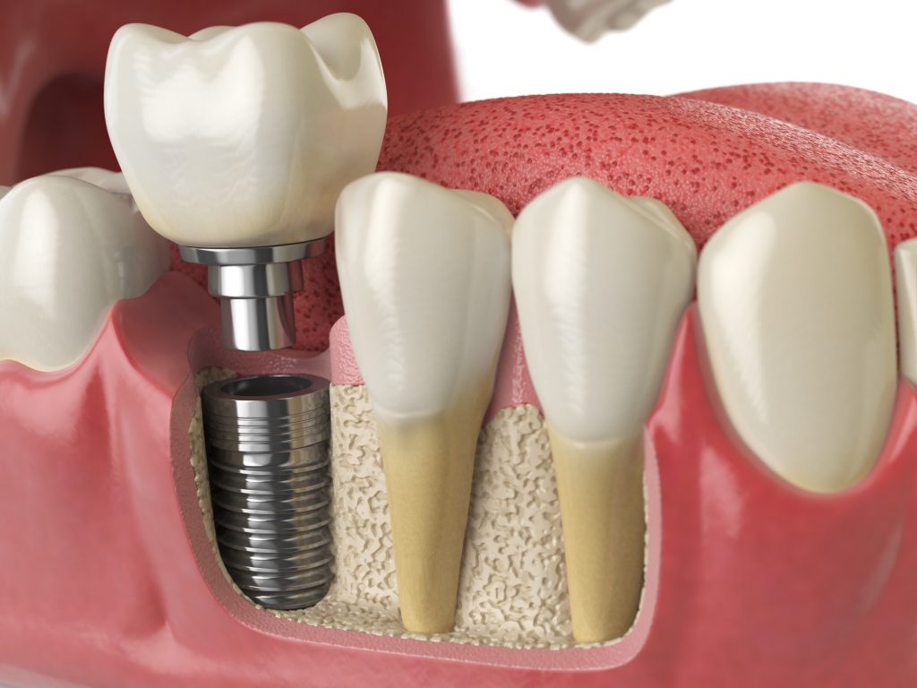Anatomy of healthy teeth and tooth dental implant in human dentu